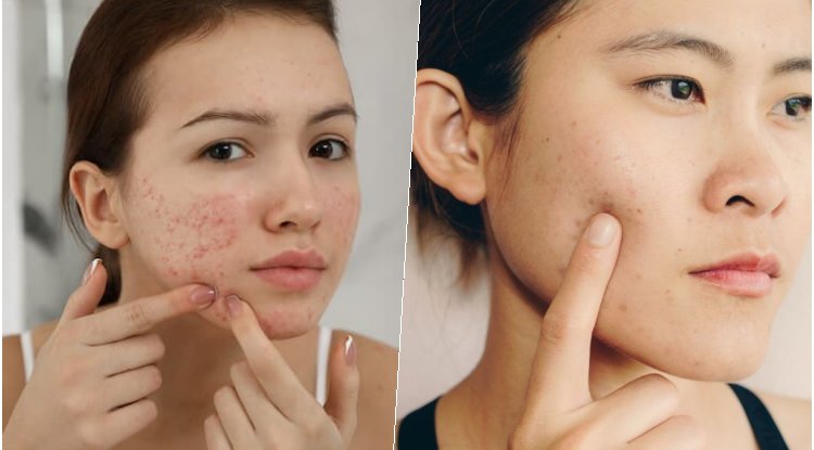 Inilah 3 Cara Paling Ampuh Menghilangkan Jerawat dengan bahan alami